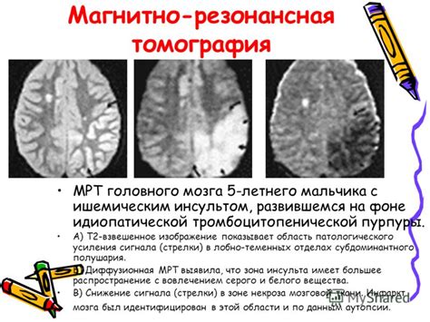 Какие симптомы сопровождают некроз мозга