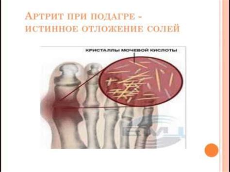 Какие симптомы сопровождают образование солей мочевой кислоты