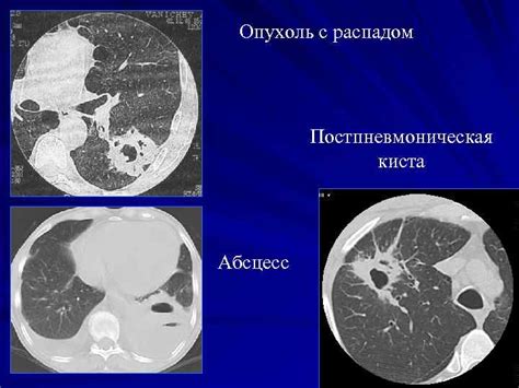 Какие симптомы сопровождают опухоль с распадом