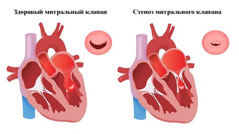 Какие симптомы сопровождают повышенное свечение створок митрального клапана?