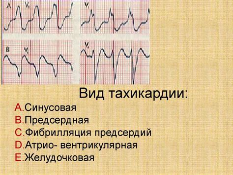 Какие симптомы сопровождают синусовую тахикардию у взрослого?