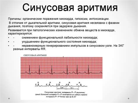 Какие симптомы сопровождают синусоидальный ритм сердца?