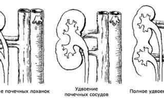 Какие симптомы сопровождают удвоение почки?