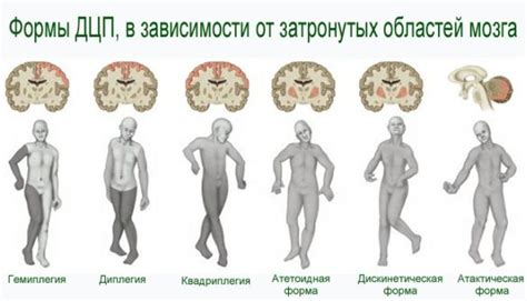 Какие симптомы указывают на легкую степень ДЦП