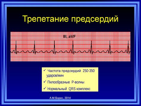 Какие симптомы характерны для фибрилляций предсердий