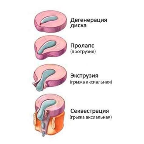 Какие существуют виды смещения позвоночника?