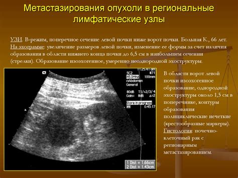 Какие факторы влияют на накопление контраста в лимфоузлах?