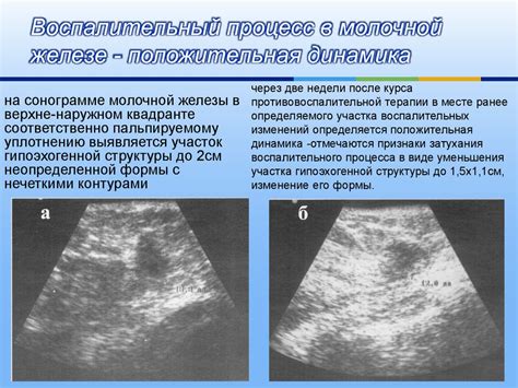 Какие факторы влияют на неровные и нечеткие контуры почек?