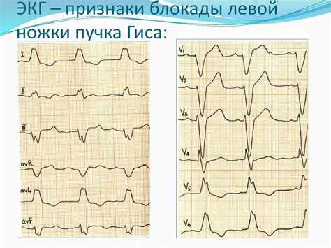 Какие факторы влияют на отклонение пучка гиса?