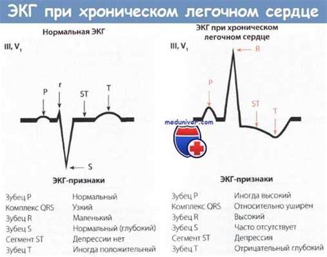 Какие факторы влияют на развитие хронического легочного сердца?