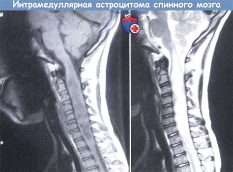 Какие факторы могут вызывать миелопатию спинного мозга?