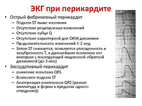 Какие факторы могут вызывать неспецифическое изменение сегмента ST?