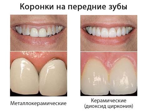 Каковы плюсы и минусы установки коронки зубные?