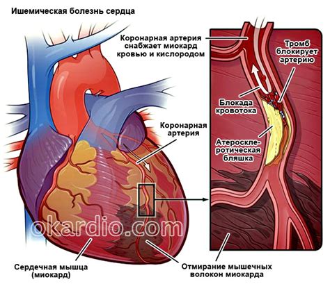 Каковы симптомы и признаки некроза сердца?