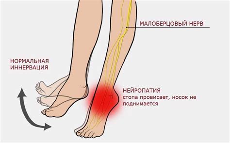 Какое влияние оказывает нейропатия на немоту стопы