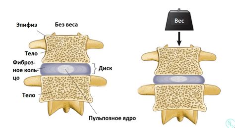 Как бороться с гипогидратацией межпозвоночных дисков