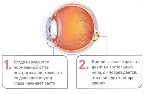 Как возникает глаукома?