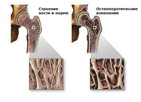 Как возникает остеопороз стоп?