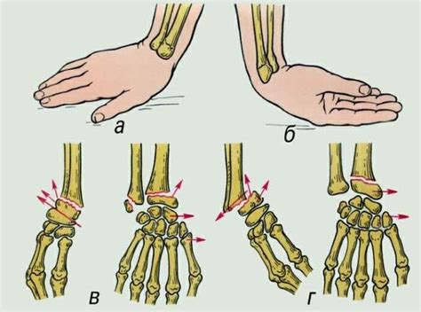 Как возникает перелом руки без смещения?