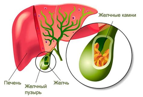 Как возникает слипшийся желчный пузырь?