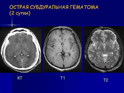 Как возникают субкортикальные очаги