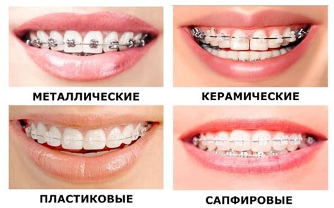 Как выбрать самолигирующие брекеты?