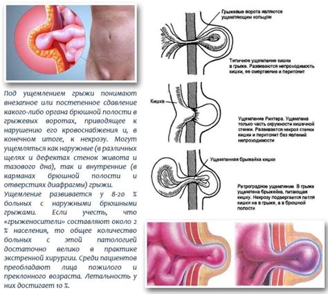 Как выявить ущемление?