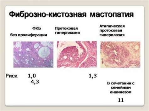 Как диагностировать ФКМ молочных желез