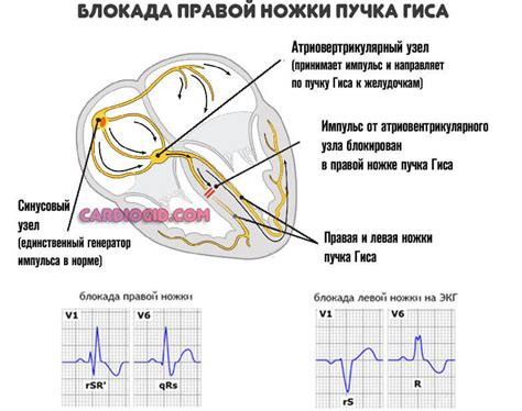 Как диагностировать блокаду левого пучка Гиса?