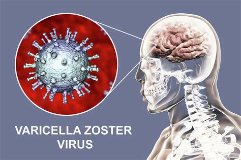 Как диагностировать вирус varicella zoster IgG