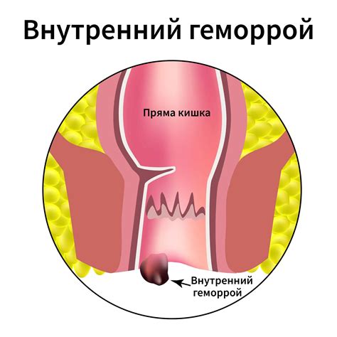 Как диагностировать внутренний геморрой у мужчин