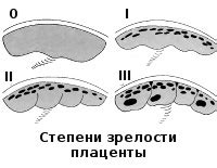 Как диагностировать и лечить неоднородную структуру плаценты с расширением МВП?