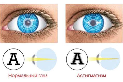 Как диагностировать миопатический астигматизм обоих глаз?