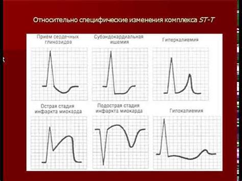 Как диагностировать нарушение реполяризации на ЭКГ?