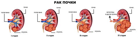 Как диагностировать размытый контур почки