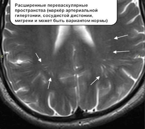 Как диагностировать расширенные периваскулярные пространства Вирхова-Робин?