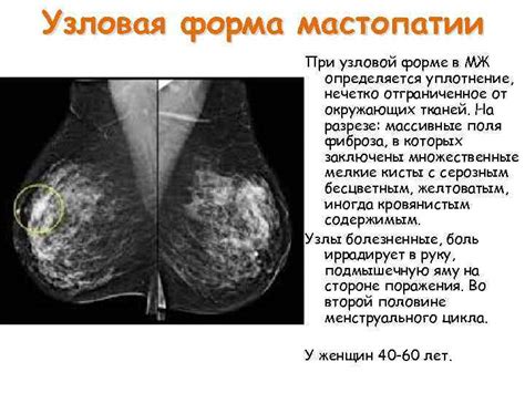 Как диагностировать узловые образования молочной железы