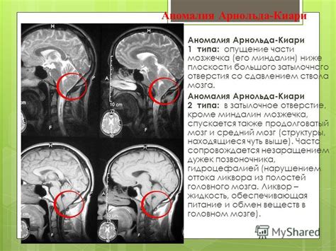 Как дистопия миндалин мозжечка влияет на организм?