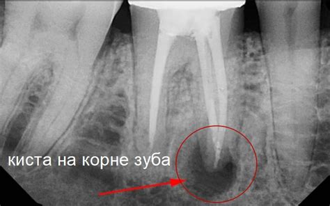 Как долго идет заживление после резекции корня зуба