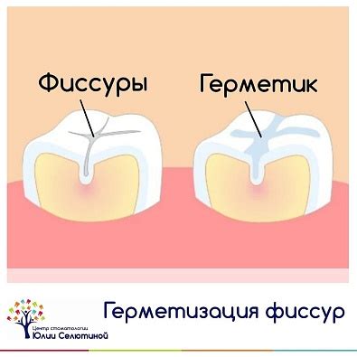 Как защитить зубы от скалывания