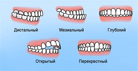 Как исправить неправильный прикус у подростков?