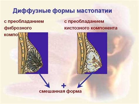 Как лечить ФКМ молочных желез