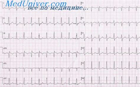 Как лечить ЭКГ ритм предсердный у ребенка?