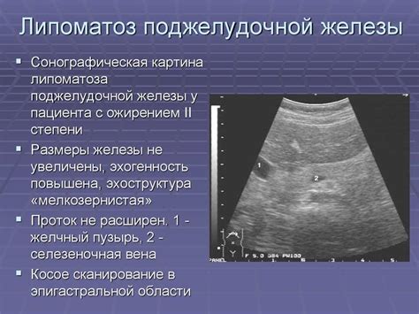 Как лечить повышенную эхогенность поджелудочной железы с нечетким контуром?