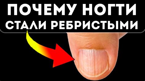 Как лечить полосатые ногти?