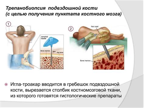 Как лечить поражение костного мозга?