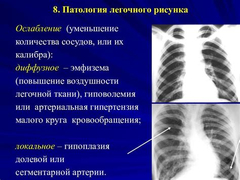 Как лечить сгущение легочного рисунка у ребенка?