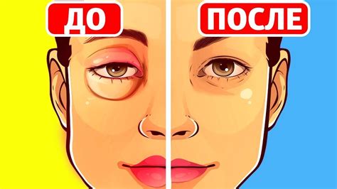 Как можно снять отек после удара