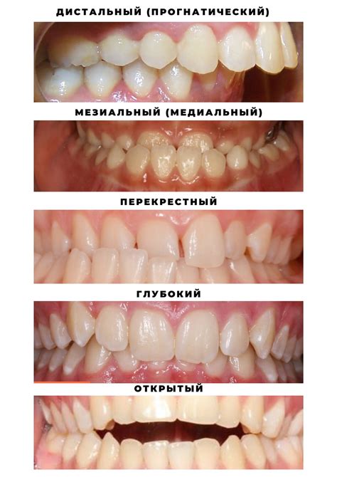 Как неправильный прикус зубов может повлиять на здоровье подростка?