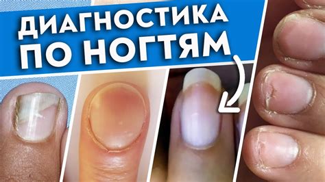 Как определить болезнь по чернению ногтей